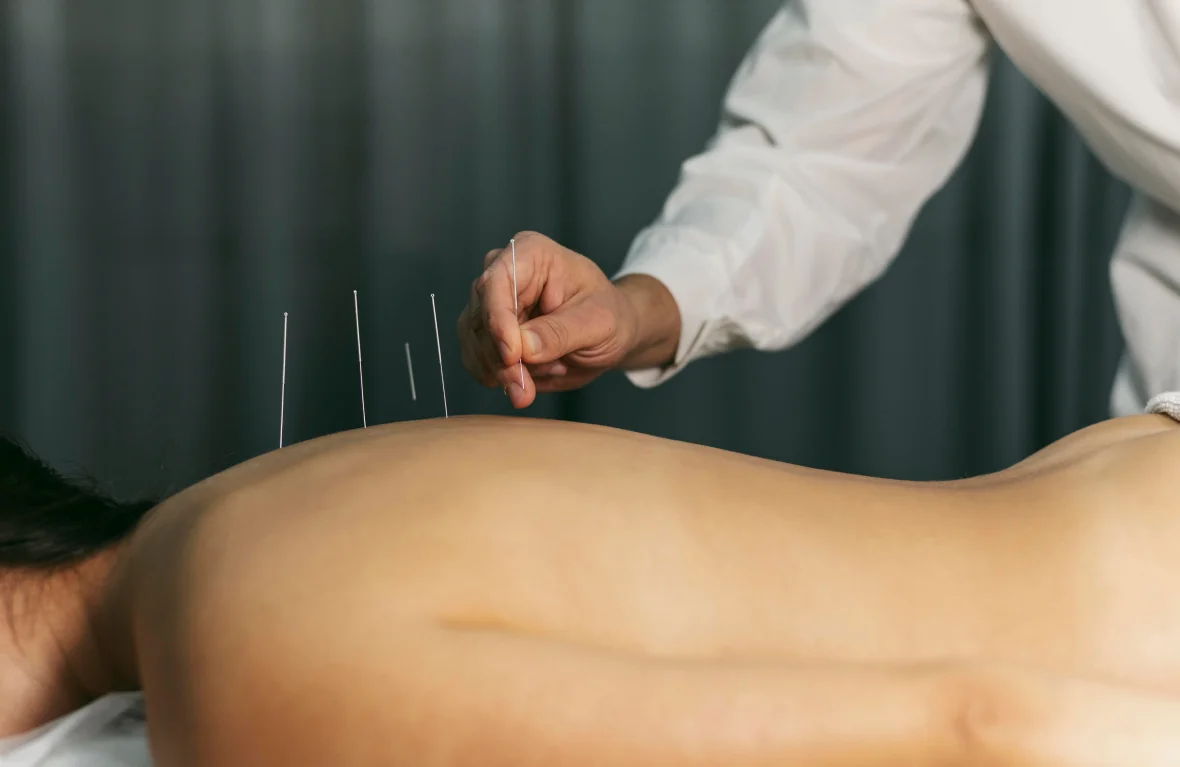 Agujas de acupuntura en la espalda de un paciente tumbado